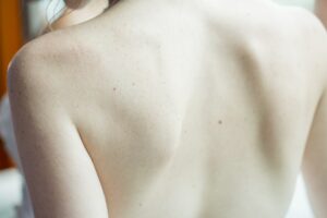 Close-up image of a woman's back, a common site for skin cancer